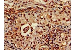 Immunohistochemistry of paraffin-embedded human lung cancer using ABIN7167701 at dilution of 1:100 (RPA1 抗体  (AA 2-616))