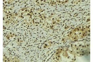 ABIN6267182 at 1/100 staining Human breast cancer tissue by IHC-P. (SMAD1 抗体  (pSer206))