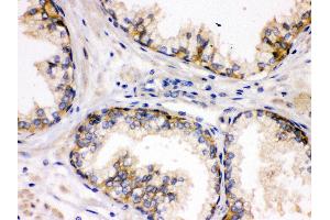 Anti- SAP97 Picoband antibody, IHC(P) IHC(P): Human Prostatic Cancer Tissue (DLG1 抗体  (AA 1-165))