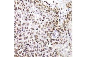 Immunohistochemistry of paraffin-embedded human well-differentiated squamous skin carcinoma using PHIP antibody (ABIN6129078, ABIN6145556, ABIN6145557 and ABIN6223036) at dilution of 1:100 (40x lens). (PHIP 抗体  (AA 1542-1821))