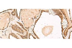 Immunohistochemistry of paraffin-embedded Human thyroid cancer tissue using FUNDC2 Polyclonal Antibody at dilution of 1:50(x200) (FUNDC2 抗体)