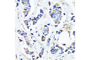Immunohistochemistry of paraffin-embedded human breast cancer using MRPL45 antibody (ABIN6133218, ABIN6144020, ABIN6144021 and ABIN6217105) at dilution of 1:100 (40x lens). (MRPL45 抗体  (AA 57-306))