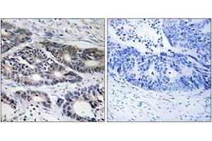 Immunohistochemistry analysis of paraffin-embedded human colon carcinoma, using Cytochrome P450 2R1 Antibody. (CYP2R1 抗体  (AA 251-300))