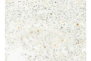 ABIN6263779 and ABIN6279623 at 1/100 staining human non-Hodgkin lymphoma by IHC-P. (NUP88 抗体  (Internal Region))