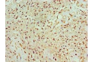 Immunohistochemistry of paraffin-embedded human breast cancer using ABIN7165122 at dilution of 1:100 (BANP 抗体  (AA 1-260))