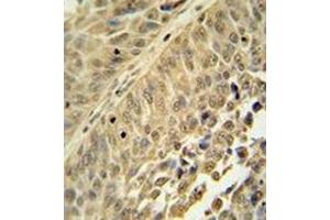 Immunohistochemistry analysis in formalin fixed and paraffin embedded human bladder carcinoma reacted with HNRNPC Antibody (C-term) followed by peroxidase conjugation of the secondary antibody and DAB staining. (HNRNPC 抗体  (C-Term))