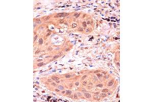Immunohistochemistry of paraffin-embedded Human lung cancer using RPP38 Rabbit pAb (ABIN7269983) at dilution of 1:100 (40x lens). (RPP38 抗体  (AA 20-110))