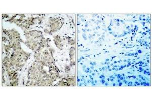 Immunohistochemical analysis of paraffin- embedded human breast carcinoma tissue, using MKK6 (phospho-Ser207) antibody (E011146). (MAP2K6 抗体  (pSer207))