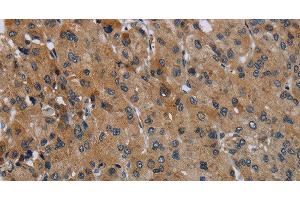 Immunohistochemistry of paraffin-embedded Human liver cancer using FAAH Polyclonal Antibody at dilution of 1:50 (FAAH 抗体)