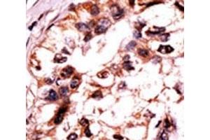 IHC analysis of FFPE human hepatocarcinoma tissue stained with the ERK3 antibody. (MAPK6 抗体  (pSer189))