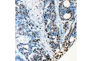 Immunohistochemical analysis of RB1 staining in human colon cancer formalin fixed paraffin embedded tissue section. (Retinoblastoma 1 抗体)