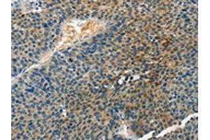 The image on the left is immunohistochemistry of paraffin-embedded Human liver cancer tissue using ABIN7190467(DGKB Antibody) at dilution 1/60, on the right is treated with synthetic peptide. (DGKB 抗体)