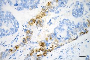 Immunohistochemistry was performed on paraffin-embedded human sigmoid colon carcinoma using phospho-NDRG1 (Ser330) antibody (ABIN7799537), 1:200). (Recombinant NDRG1 抗体  (pSer330))