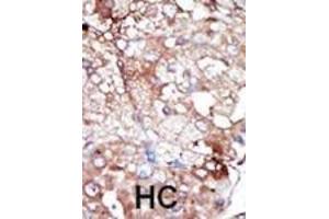 Formalin-fixed and paraffin-embedded human cancer tissue reacted with the primary antibody, which was peroxidase-conjugated to the secondary antibody, followed by DAB staining. (GAK 抗体  (C-Term))