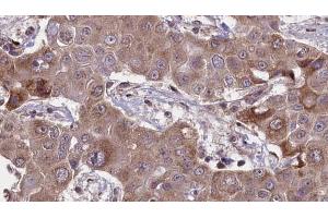 ABIN6269031 at 1/100 staining Human liver cancer tissue by IHC-P. (PDGFRA 抗体  (C-Term))