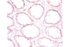 Immunohistochemistry of paraffin-embedded human colon cancer using ABIN7165284 at dilution of 1:50 (P4HB 抗体  (AA 29-508))