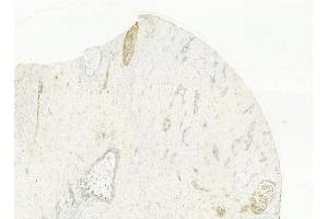 ABIN6262096 and ABIN6278471 at 1/100 staining human hepatocellular carcinoma by IHC-P. (GRO gamma 抗体  (C-Term))