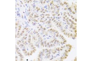 Immunohistochemistry of paraffin-embedded human thyroid cancer using HDGF Antibody. (HDGF 抗体  (AA 1-240))