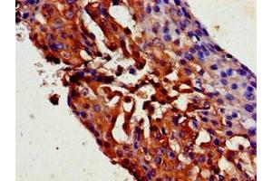 Immunohistochemistry of paraffin-embedded human breast cancer using ABIN7169527 at dilution of 1:100 (TRPC1 抗体  (AA 39-207))
