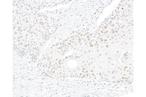 Immunohistochemistry (IHC) image for anti-Bloom Syndrome RecQ Like Helicase (BLM) (C-Term) antibody (ABIN7795726) (Recombinant BLM 抗体  (C-Term))