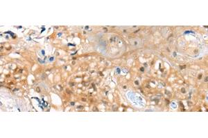 Immunohistochemistry of paraffin-embedded Human esophagus cancer tissue using CBR3 Polyclonal Antibody at dilution of 1:35(x200) (CBR3 抗体)