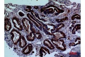 Immunohistochemistry (IHC) analysis of paraffin-embedded Human Prostate Cancer, antibody was diluted at 1:100. (LY9 抗体  (Internal Region))