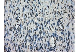 Immunohistochemical staining of paraffin-embedded Carcinoma of lung tissue using anti-STK39mouse monoclonal antibody. (STK39 抗体)