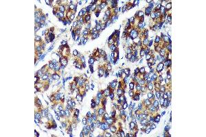 Immunohistochemistry of paraffin-embedded Human liver cancer using PLEKHB2 Rabbit pAb (ABIN7269415) at dilution of 1:100 (40x lens). (PLEKHB2 抗体  (AA 1-222))