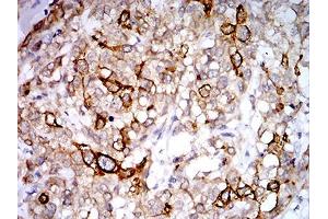 Immunohistochemical analysis of paraffin-embedded breast cancer tissues using PGRMC1 mouse mAb with DAB staining. (PGRMC1 抗体  (AA 1-195))