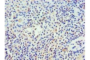 Immunohistochemistry of paraffin-embedded human breast cancer using ABIN7161360 at dilution of 1:100 (NCS1 抗体  (AA 1-190))