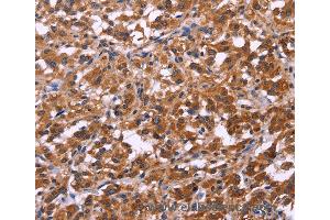 Immunohistochemistry of Human cervical cancer using SPATA7 Polyclonal Antibody at dilution of 1:30 (SPATA7 抗体)