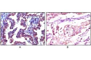 Immunohistochemical analysis of paraffin-embedded human metastatic adenocarcinoma(A) and stomach adenocarcinoma (B), showing cytoplasmic localization using Trim5α mouse mAb with AEC staining (A) and DAB staining(B). (TRIM5 抗体)