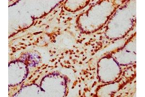IHC image of ABIN7163675 diluted at 1:200 and staining in paraffin-embedded human gastric cancer performed on a Leica BondTM system. (PHLDB1 抗体  (AA 233-423))