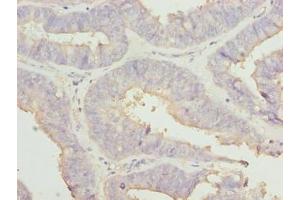Immunohistochemistry of paraffin-embedded human endometrial cancer using ABIN7167001 at dilution of 1:100 (RABGEF1 抗体  (AA 1-491))