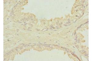 Immunohistochemistry of paraffin-embedded human prostate cancer using ABIN7151649 at dilution of 1:100 (SH3GLB2 抗体  (AA 1-250))