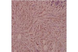 Immunohistochemistry (IHC) analyzes of CD124 / IL4R Antibody in paraffin-embedded human breast carcinoma tissue at 1/100. (IL4 Receptor 抗体)