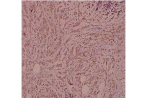 Immunohistochemistry (IHC) analyzes of CD124 / IL4R Antibody in paraffin-embedded human breast carcinoma tissue at 1/100. (IL4 Receptor 抗体)