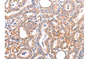 The image on the left is immunohistochemistry of paraffin-embedded Human thyroid cancer tissue using ABIN7128444(AOC1 Antibody) at dilution 1/15, on the right is treated with fusion protein. (DAO 抗体)