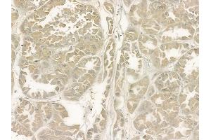 ABIN6266307 and ABIN6277426 at 1/100 staining human renal cell carcinoma by IHC-P.
