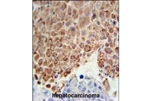 PHGDH Antibody (Center) (ABIN650767 and ABIN2839544) immunohistochemistry analysis in formalin fixed and paraffin embedded human hepatocarcinoma followed by peroxidase conjugation of the secondary antibody and DAB staining. (PHGDH 抗体  (AA 249-277))