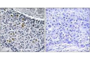 Immunohistochemistry analysis of paraffin-embedded human breast carcinoma, using MAD1 (Phospho-Ser428) Antibody.