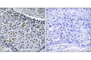 Immunohistochemistry analysis of paraffin-embedded human breast carcinoma, using MAD1 (Phospho-Ser428) Antibody.
