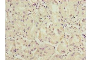 Immunohistochemistry of paraffin-embedded human gastric cancer using ABIN7174864 at dilution of 1:100 (C6orf141 抗体  (AA 1-237))