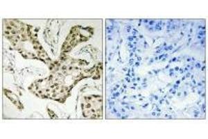 Immunohistochemistry analysis of paraffin-embedded human liver carcinoma tissue using TOP2A antibody. (Topoisomerase II alpha 抗体  (N-Term))