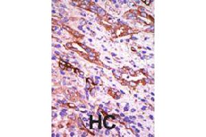 Formalin-fixed and paraffin-embedded human hepatocellular carcinoma tissue reacted with GRK1 polyclonal antibody  , which was peroxidase-conjugated to the secondary antibody, followed by DAB staining . (GRK1 抗体  (C-Term))