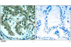 Immunohistochemical analysis of paraffin-embedded human lung carcinoma tissue using PRKCQ polyclonal antibody . (PKC theta 抗体)