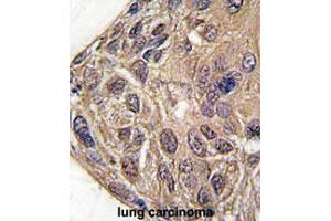 Formalin-fixed and paraffin-embedded human lung carcinomareacted with YARS polyclonal antibody , which was peroxidase-conjugated to the secondary antibody, followed by AEC staining. (YARS 抗体  (C-Term))