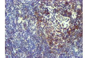 Immunohistochemical staining of paraffin-embedded Human lymphoma tissue using anti-NMT2 mouse monoclonal antibody. (NMT2 抗体)