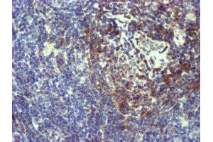 Immunohistochemical staining of paraffin-embedded Human lymphoma tissue using anti-NMT2 mouse monoclonal antibody. (NMT2 抗体)