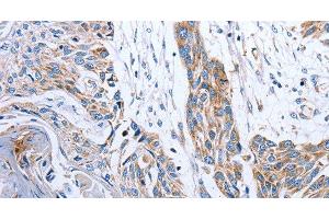 Immunohistochemistry of paraffin-embedded Human esophagus cancer tissue using NDUFA12 Polyclonal Antibody at dilution 1:50 (NDUFA12 抗体)